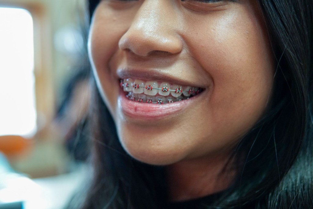 Braces Cost Chicago IL, 3020 Orthodontics